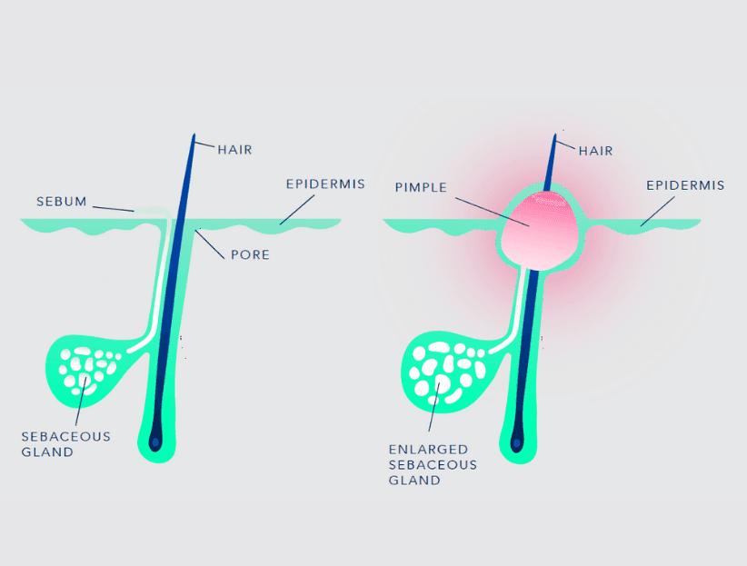 Illustration explaining the causes of acne, featuring labeled images of clogged pores, bacteria, oil production, and hormonal changes.