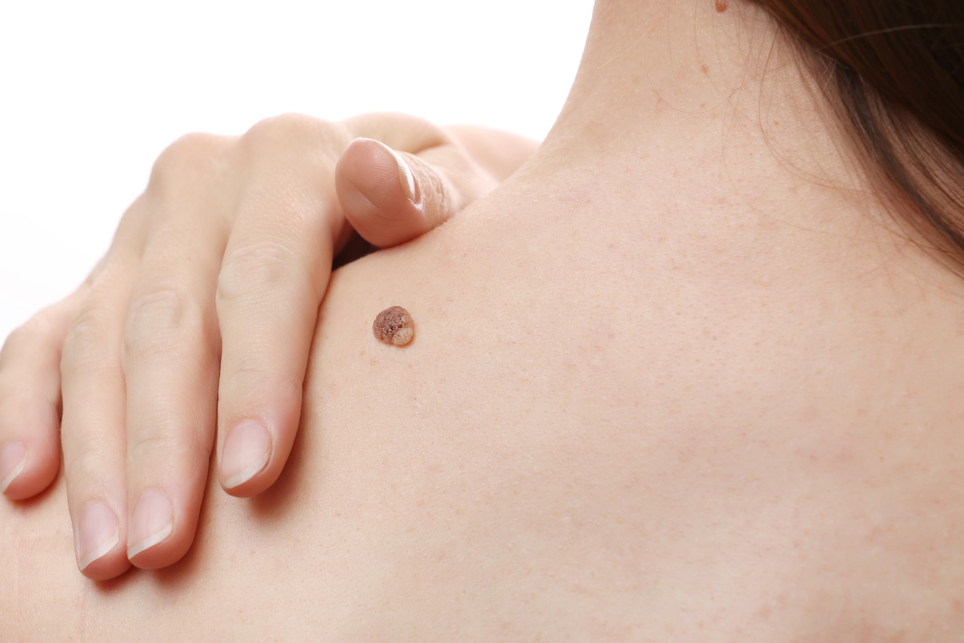 large mole on young female shoulder, woman visiting provider, regular examination and treatment.